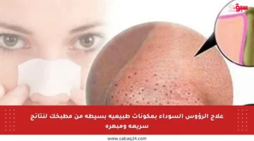 علاج الرؤوس السوداء بمكونات طبيعية بسيطة من مطبخك لنتائج سريعة ومبهرة
